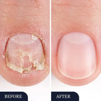 Anti-Fungal Precision Nail Pen