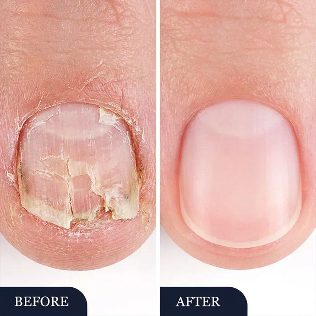 Anti-Fungal Precision Nail Pen